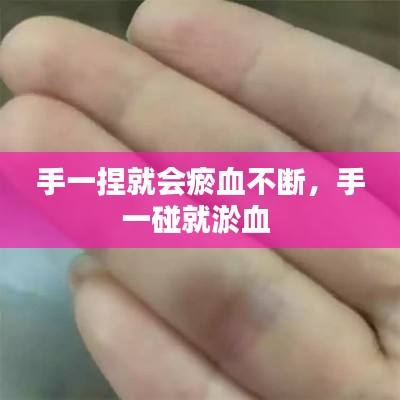 手一捏就会瘀血不断,手一碰就淤血
