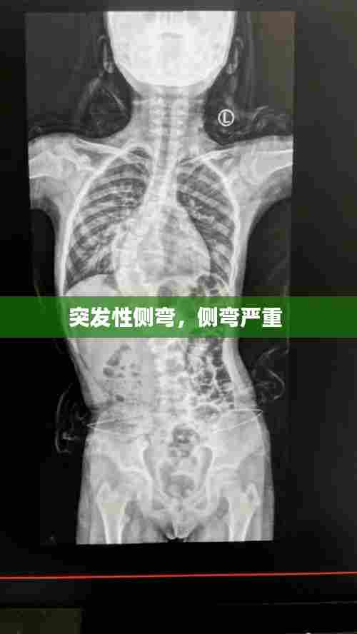 突发性侧弯，侧弯严重 