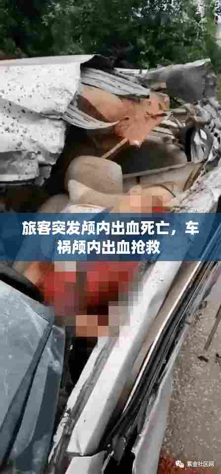 旅客突发颅内出血死亡,车祸颅内出血抢救