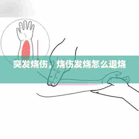 突发烧伤，烧伤发烧怎么退烧 