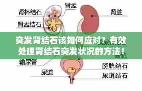 突发肾结石该如何应对?有效处理肾结石突发状况的方法!