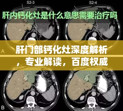 肝门部钙化灶深度解析，专业解读，百度权威资料一网打尽