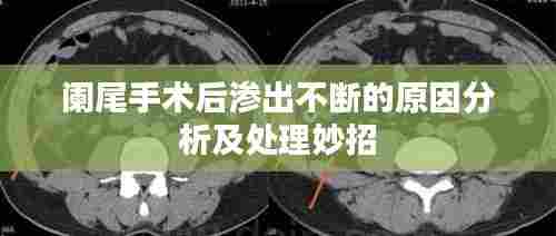 阑尾手术后渗出不断的原因分析及处理妙招